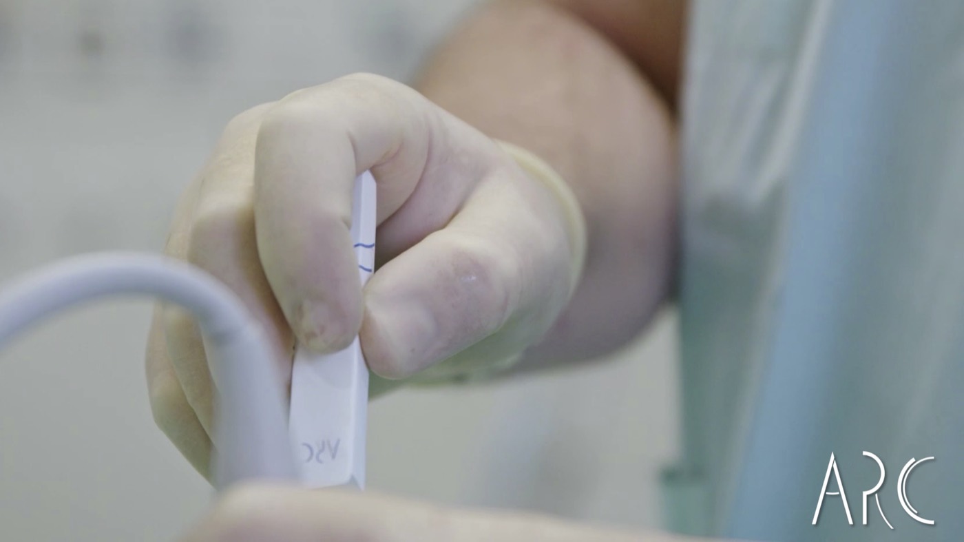 ARC handle and echography