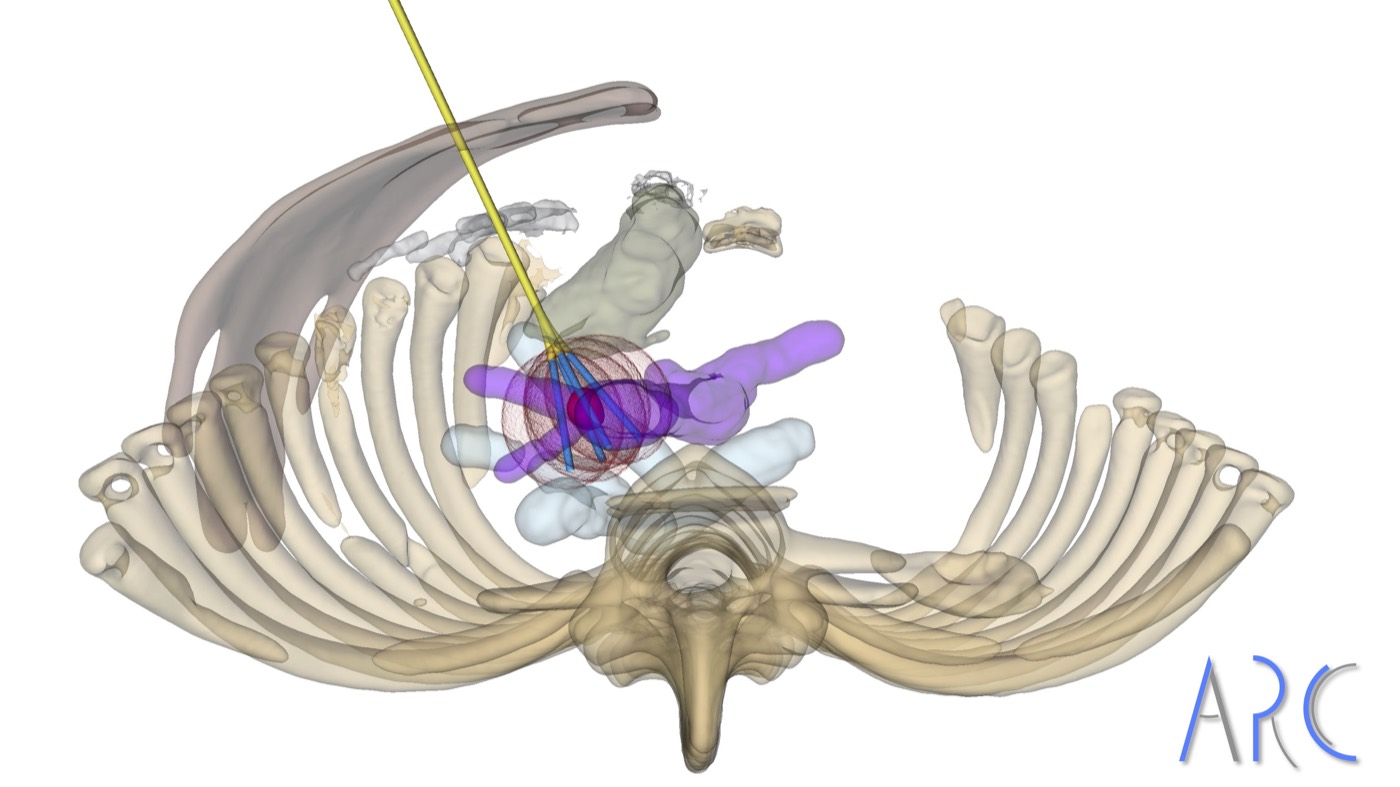 ARC needle insertion planning